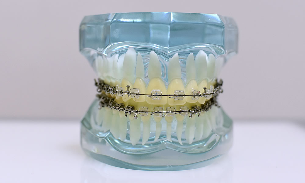 画像：歯科矯正治療の流れ4