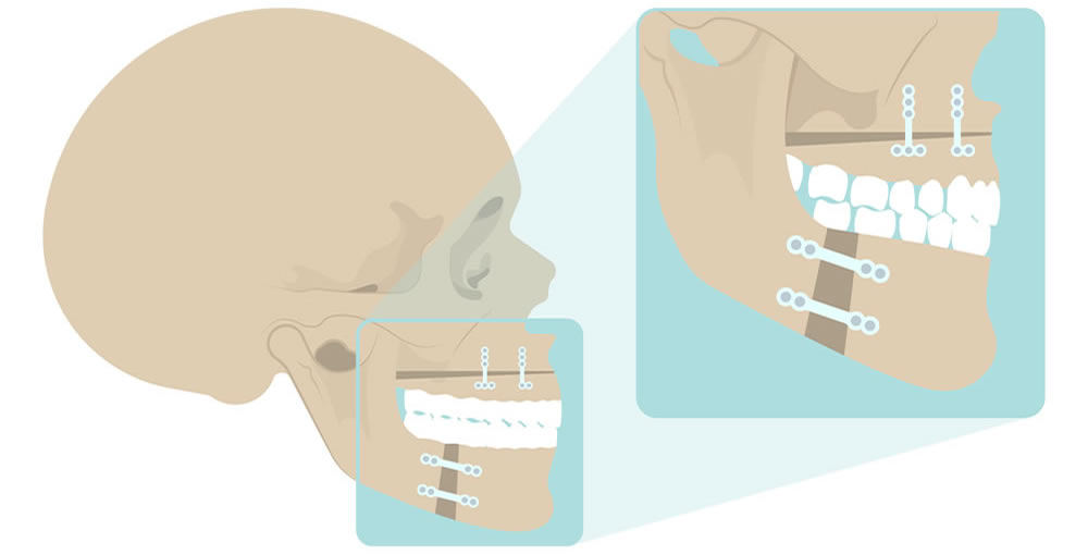 画像：顎変形症の外科的矯正治療について