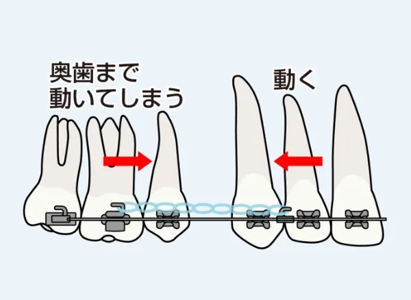 歯を移動させる方法