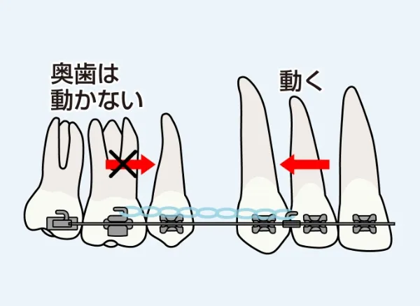 ヘッドギアを使った従来の方法