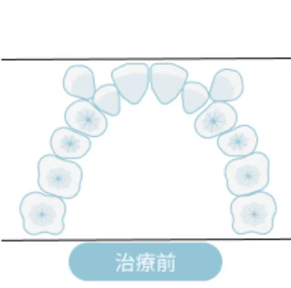 非抜歯矯正の治療方法