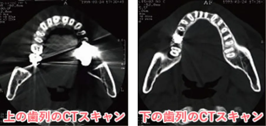 なぜ歯周病の原因になるのか