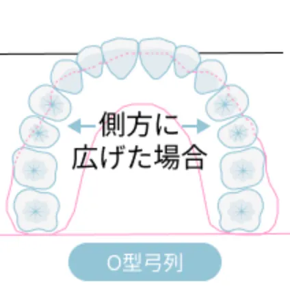 非抜歯治療（2）