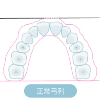 抜歯をした場合