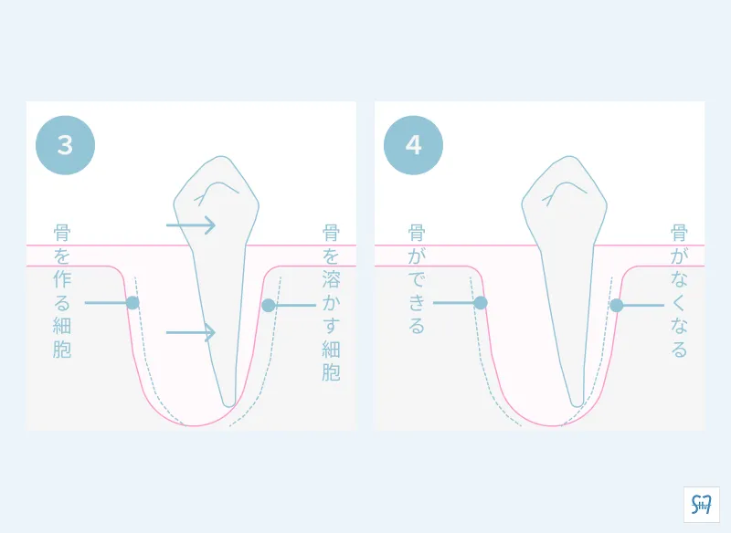 治療期間に関わる矯正の仕組み