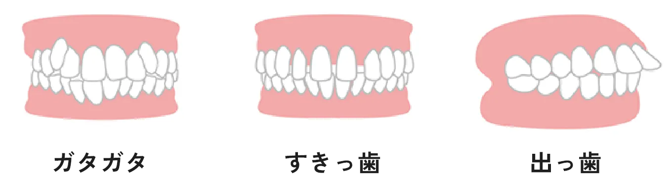 ガタガタ・すきっ歯・出っ歯