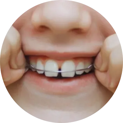 子どもの矯正（小児矯正）