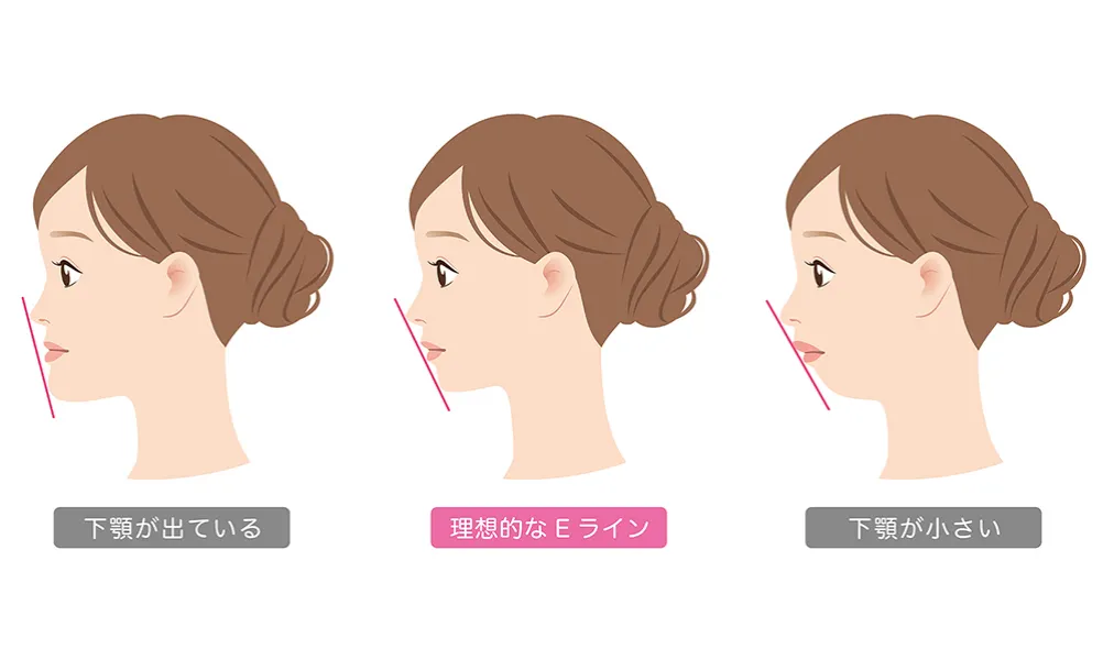 顎変形症について